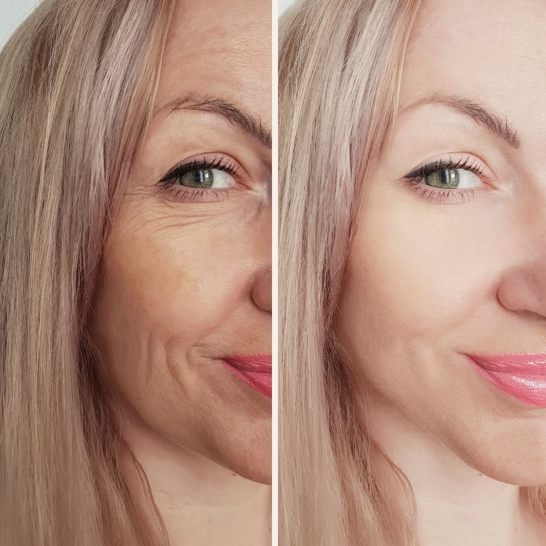 Before And After Aurora Plastic Surgery 1