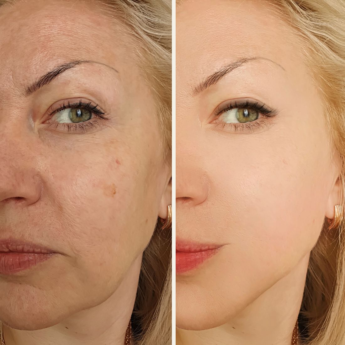 Before And After Aurora Plastic Surgery 5