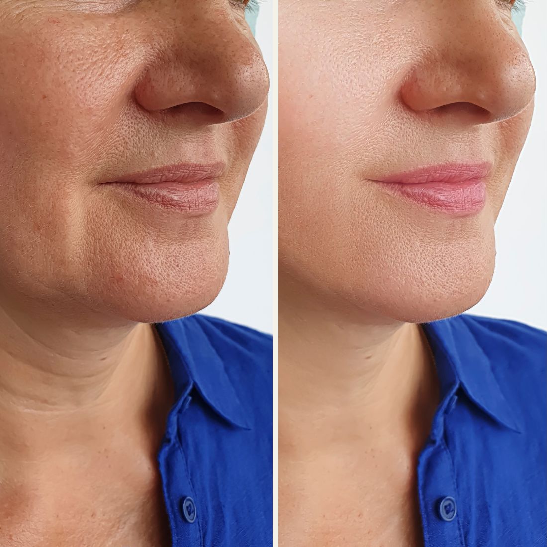 Before And After Aurora Plastic Surgery 6