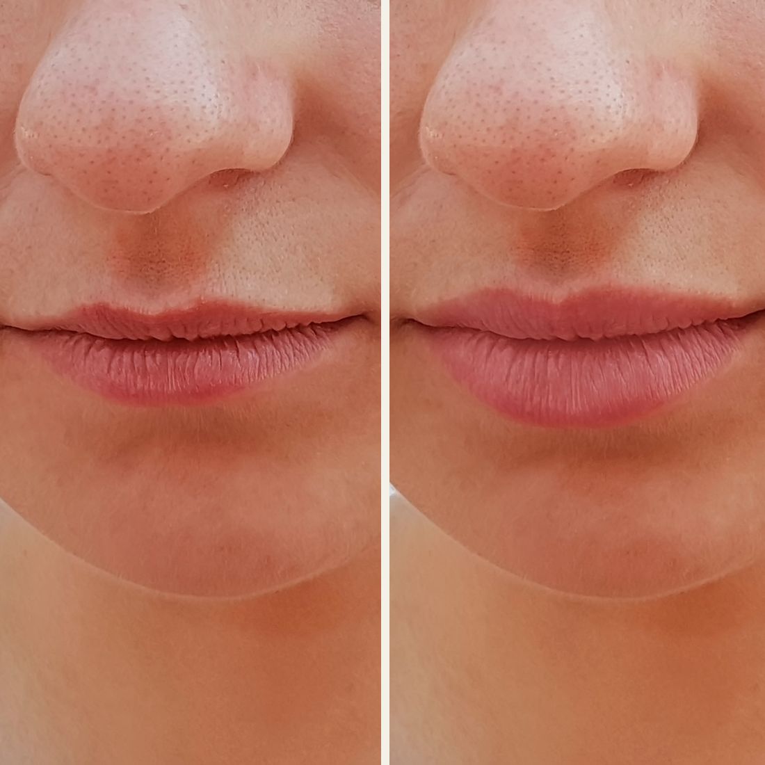 Before And After Aurora Plastic Surgery 7