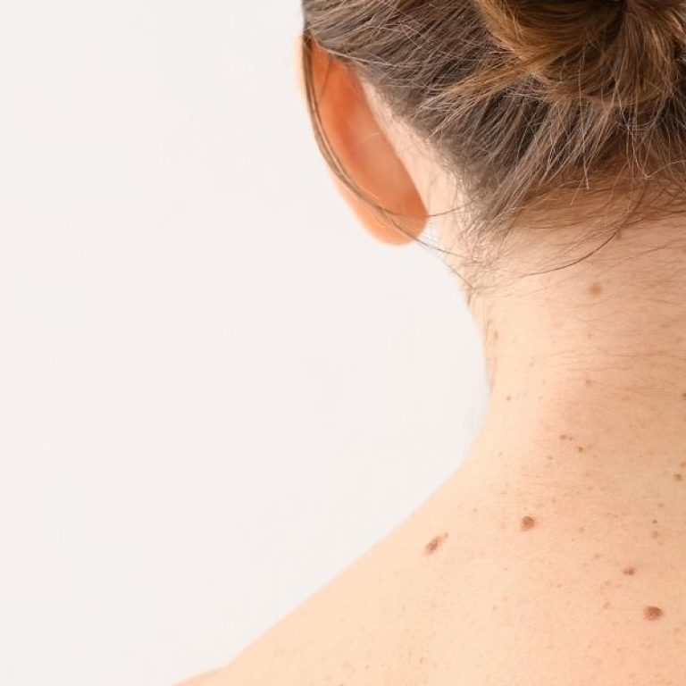 Cosmetic Mole Removal in Aurora What to Know Before Treatment