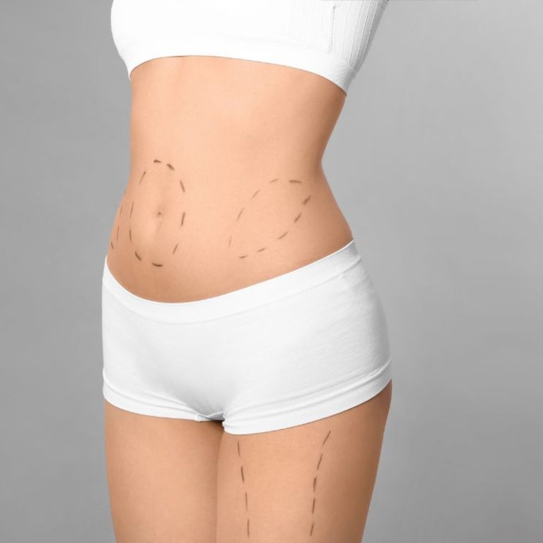 Liposuction Main Image Aurora