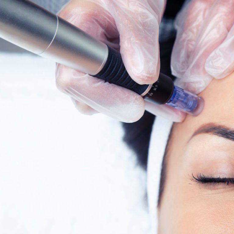 Microneedling Main Image Aurora