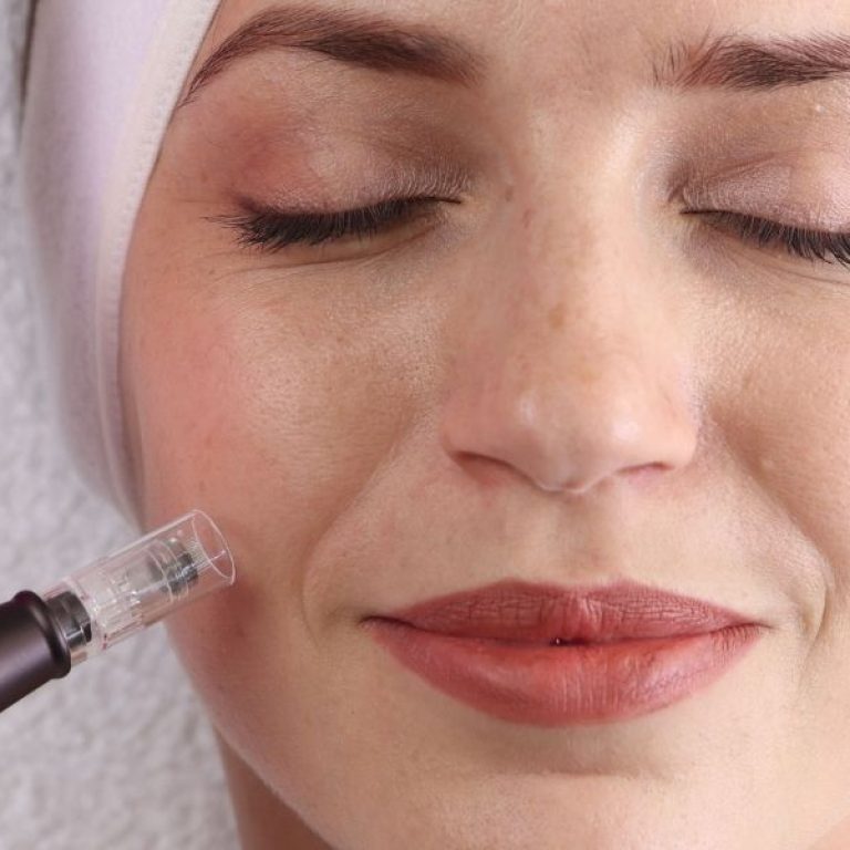 What Is Microneedling and How Does It Work